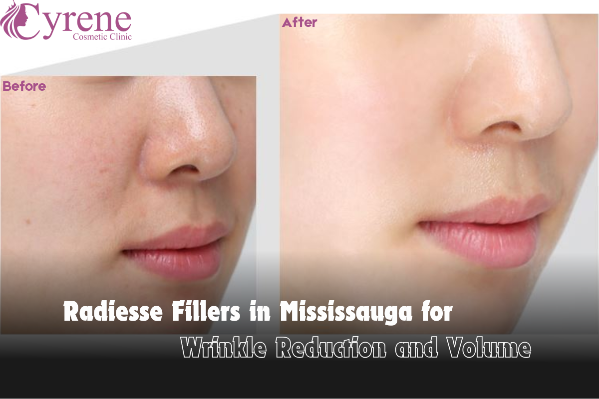 Radiesse Fillers In Mississauga For Wrinkle Reduction And Volume