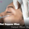 What Happens When Dermal Fillers Dissolve